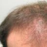 Cómo el cabello debilitado y la pérdida de cabello impacta tu confianza y qué hacer al respecto