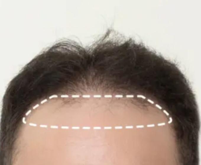 Guía de Expertos: Cómo Elegir una Prótesis Capilar Frontal para Hombre