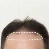 Guía de Expertos: Cómo Elegir una Prótesis Capilar Frontal para Hombre
