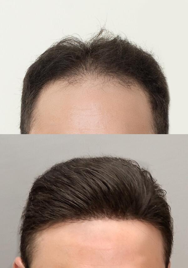 Tupé Frontal de Skin Super Delgado de Apariencia Realista