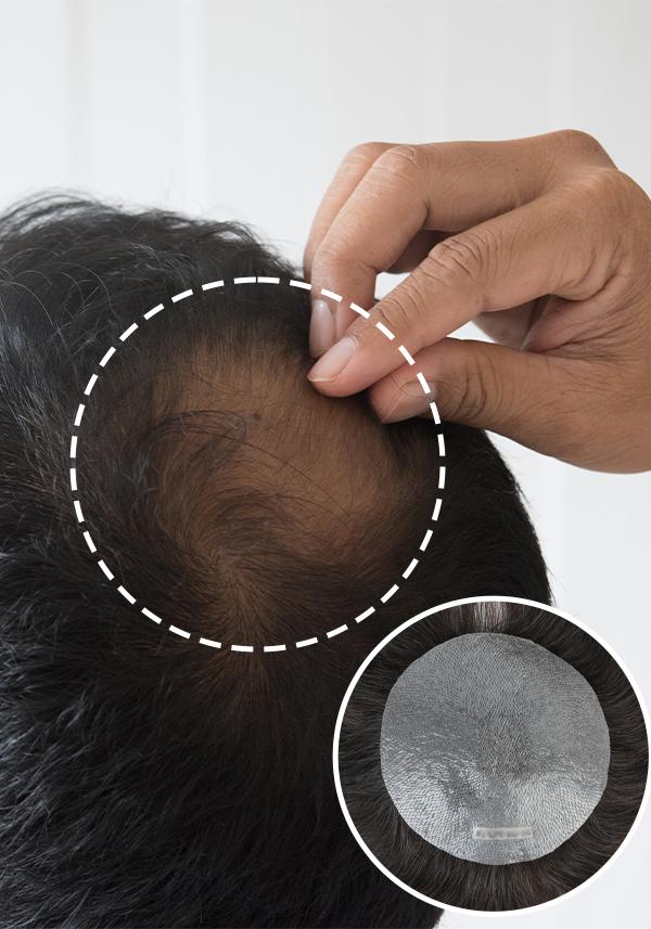 Parche de Prótesis Capilar para Pérdida de Cabello en la Coronilla. Realista y de Fácil Colocación