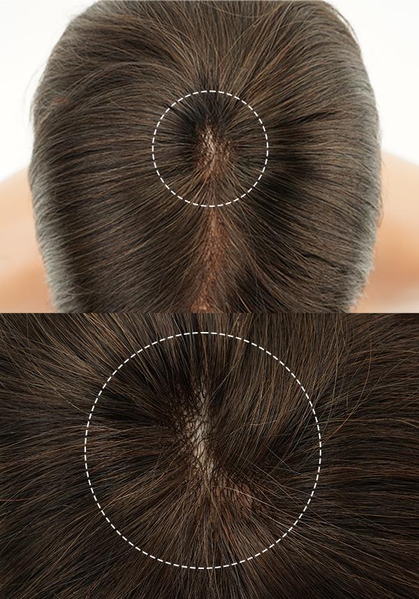 Parche de prótesis capilar de skin de cabello real para pérdida de cabello en el área de la coronilla e indetectable