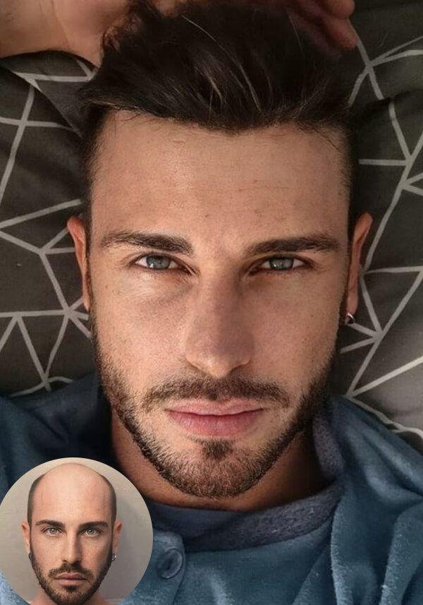 Hombre usando Prótesis Capilar de Skin Super Delgado y Encaje Francés Frontal de cabello real