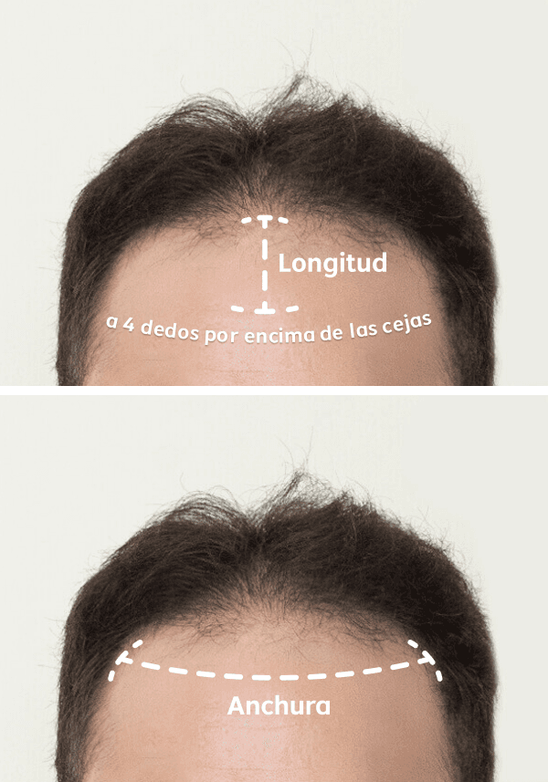 Prótesis Capilar Frontal de Skin Super Delgado de Apariencia Realista