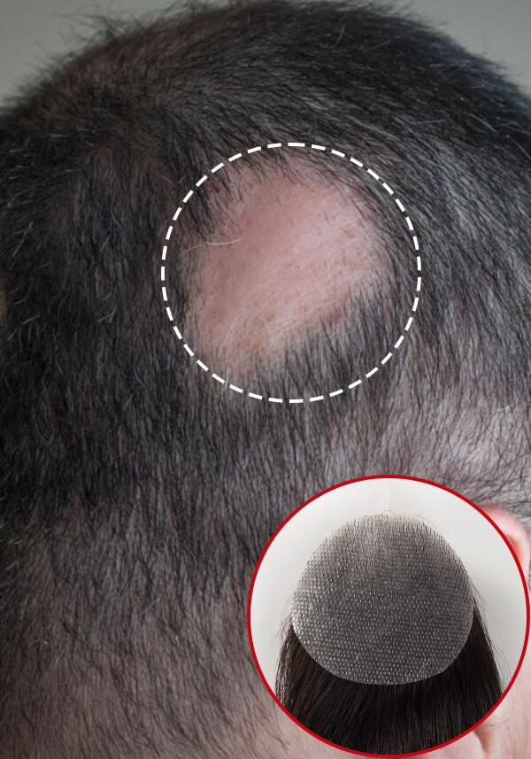Peluca tipo Parche para Pérdida de Cabello Tipo Lateral (2pzas). Realistas y de Fácil Colocación