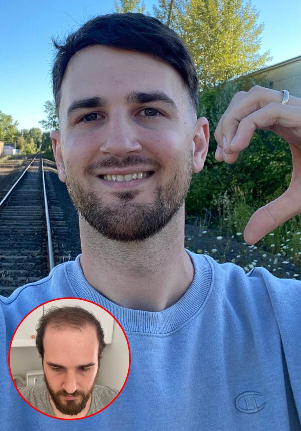 Prótesis Capilar para hombre con cabello corto precortado de cabello real