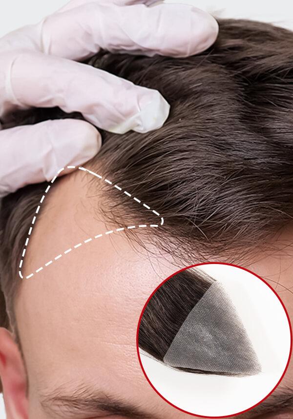 Peluca topo Parche para Pérdida de Cabello en las Sienes (2 pzas) - Realistas y de Fácil Colocación