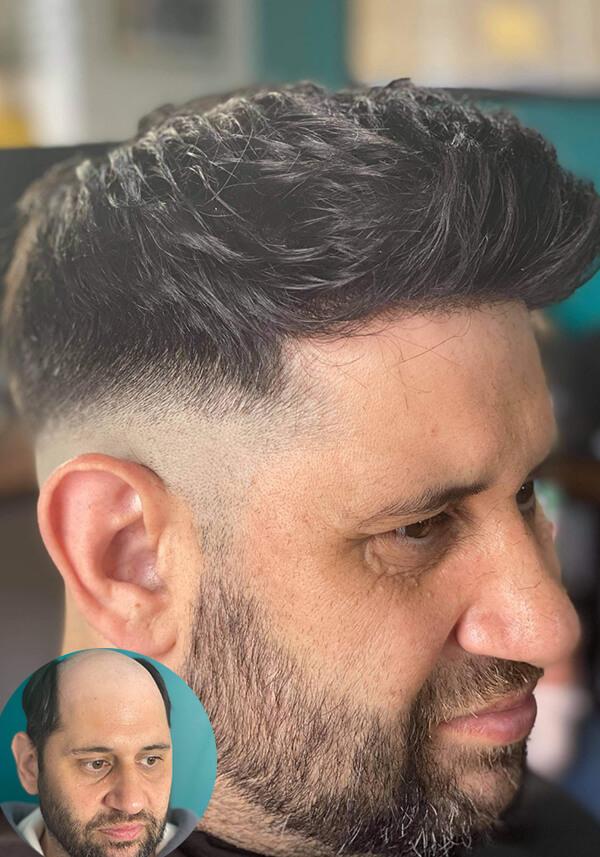 Hombre con tupé antes y despues
