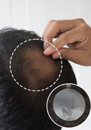 Parche de Prótesis Capilar para Pérdida de Cabello en la Coronilla. Realista y de Fácil Colocación