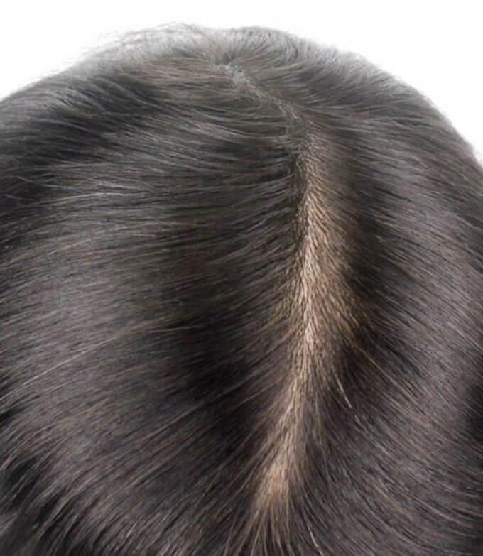 Diferencias Entre las Prótesis Capilares de Cabello Inyectado: Plano y con Elevación