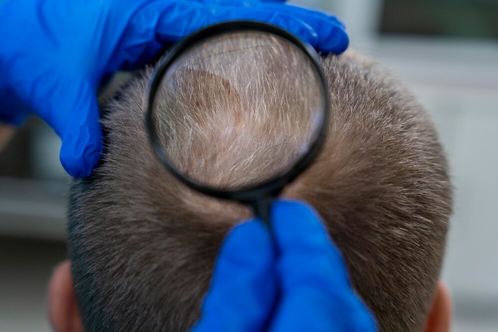alopecia cicatrical y no cicatrical