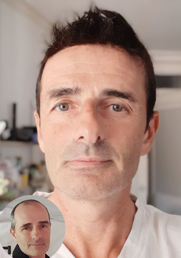 Como reaccionar ante comentarios negativos sobre las protesis capilares