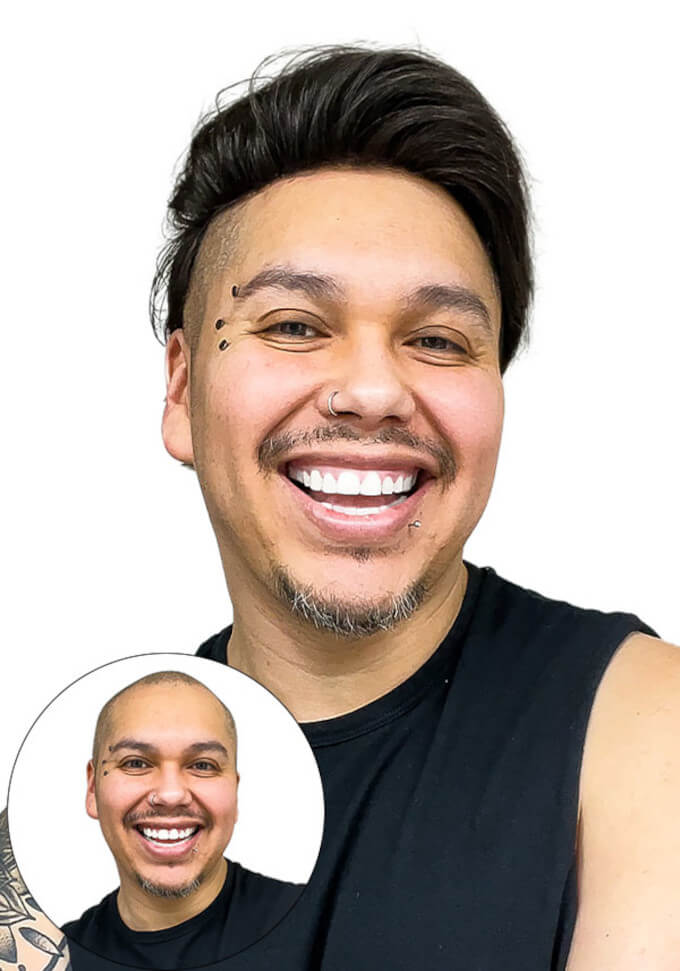 antes y después de colocar una prótesis capilar para hombre