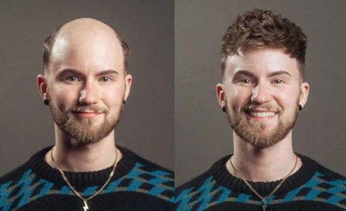 métodos no invasivos de recuperación de cabello