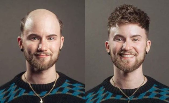 Antes y después con prótesis capilar de skin