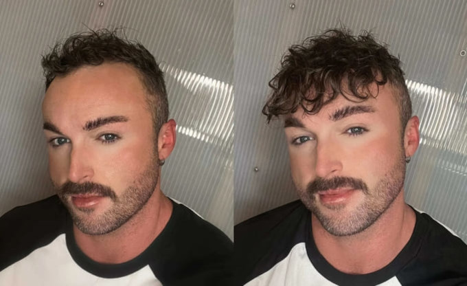 Antes & Despues - Prótesis Capilar Frontal para Hombre