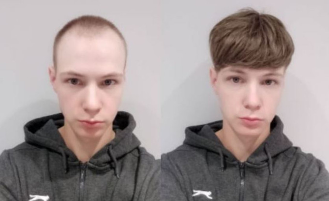 Prótesis Capilares para Hombres Jóvenes