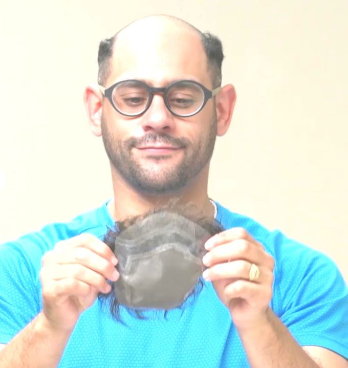 Hombre que ha removido su prótesis capilar
