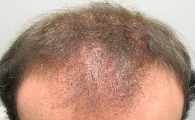 El impacto emocional por el debilitamiento y pérdida de cabello