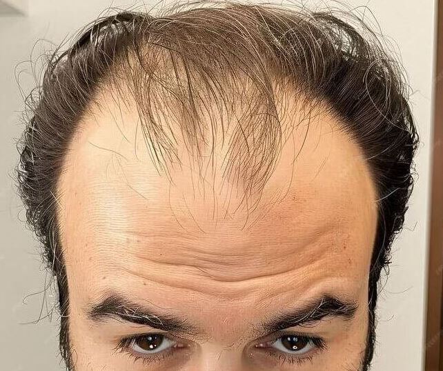 Es correcto o no normalizar la pérdida de cabello