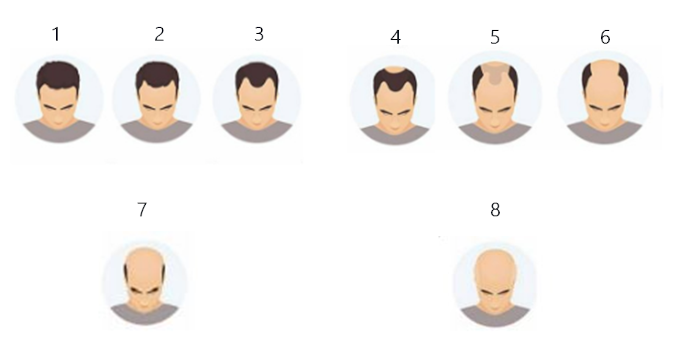 escala Hamilton-Norwood