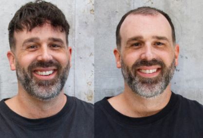 Antes y después de estilizado de prótesis capilar en hombre con cara redonda