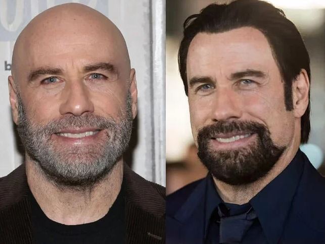 Celebridades que normalizan el uso de prótesis capilares