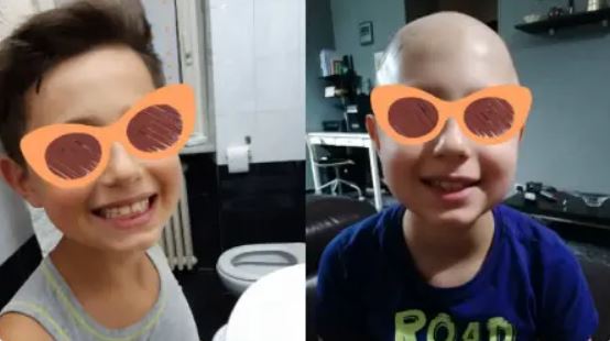Prótesis capilares para niños- soluciones libres de riesgo para la alopecia