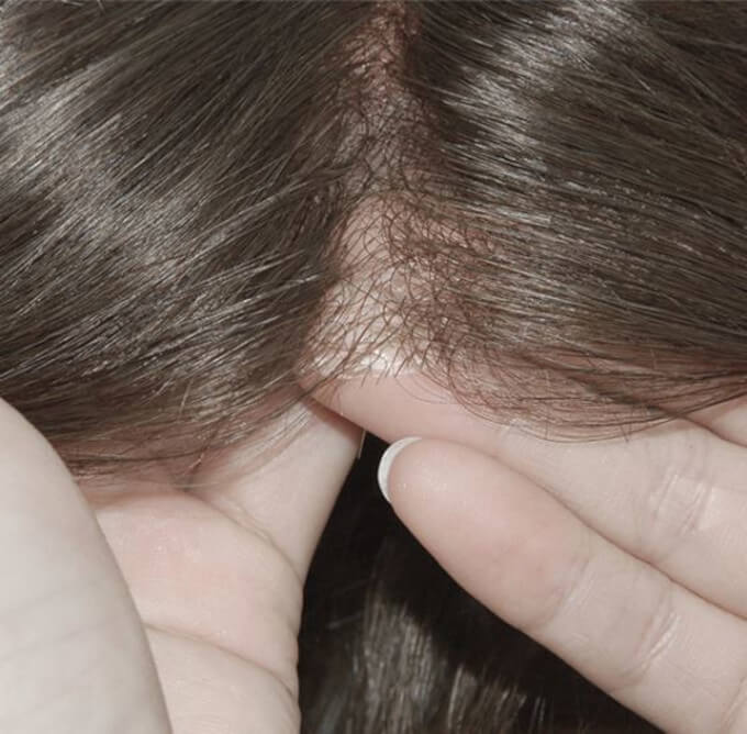 línea del cabello realista en prótesis capilares