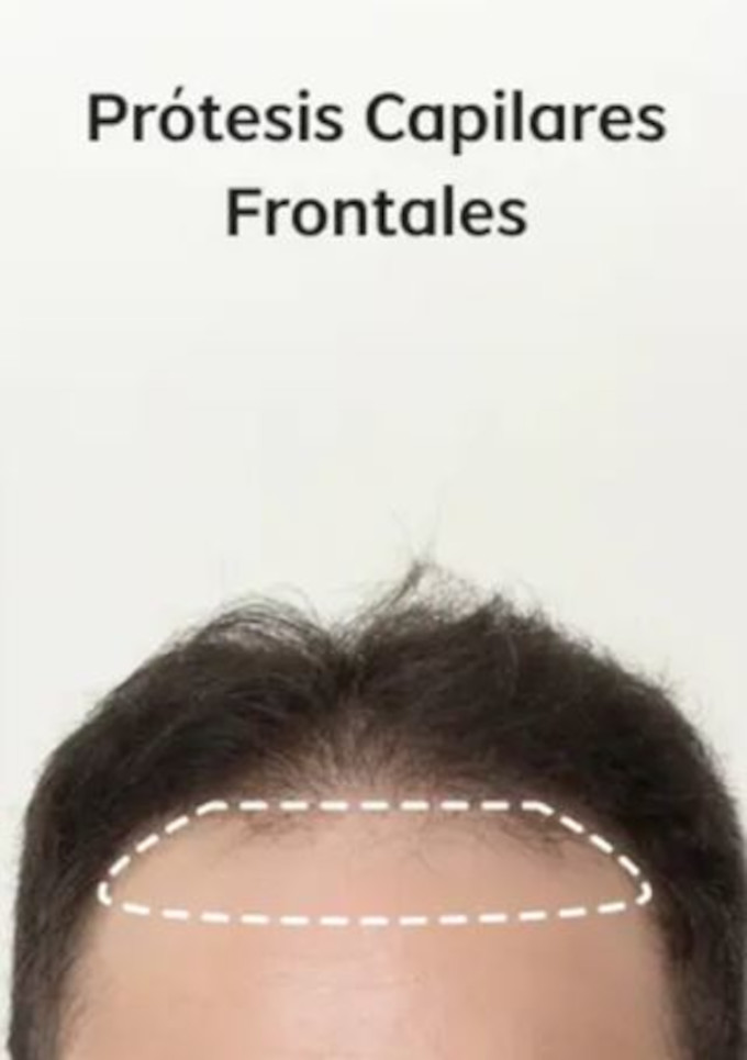 Prótesis Capilar para Hombre Tipo Frontal