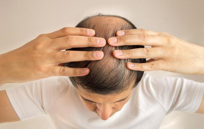 Pérdida de cabello en la coronilla ¿Usar o no una prótesis capilar?