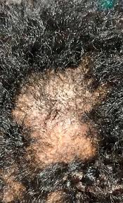 Alopecia Central Centrífuga - Causa Común de Pérdida de Cabello en Hombres Afro
