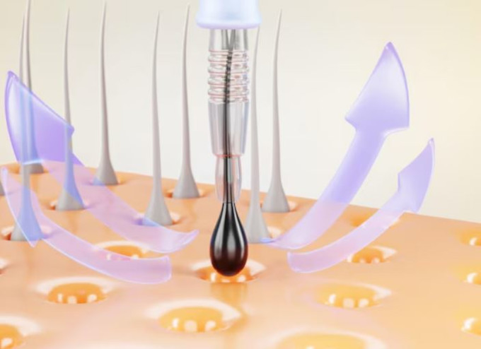 Traspantes de Cabello a base de Inteligencia Artificial y Robótica para la Pérdida de Cabello