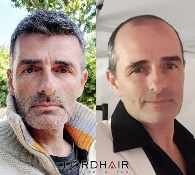 Privacidad sobre la pérdida de cabello y el uso de prótesis capilares