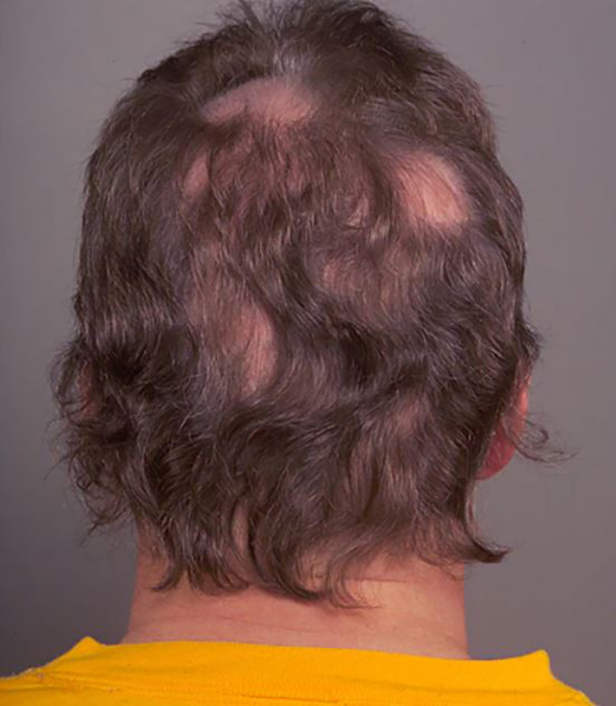 ¿Usar una peluca si padezco pérdida de cabello en forma de parches?