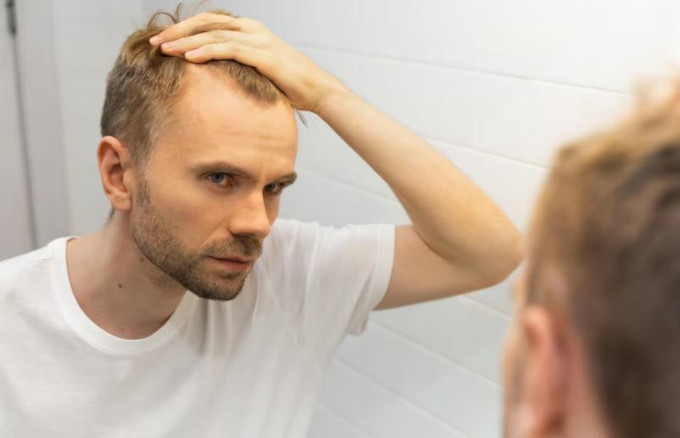 Como influye la presión social de la pérdida de cabello