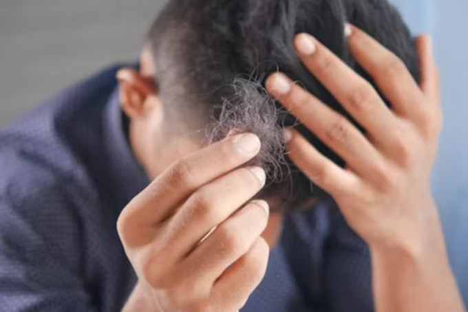 ¿Es pérdida de cabello temporal ó crónica?