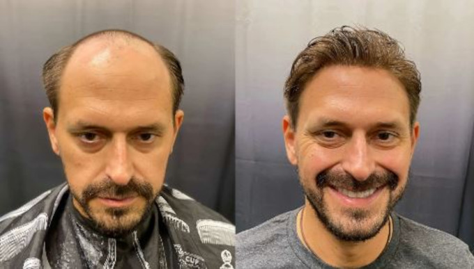 antes y despues- hombre usando protesis capilar indetectable