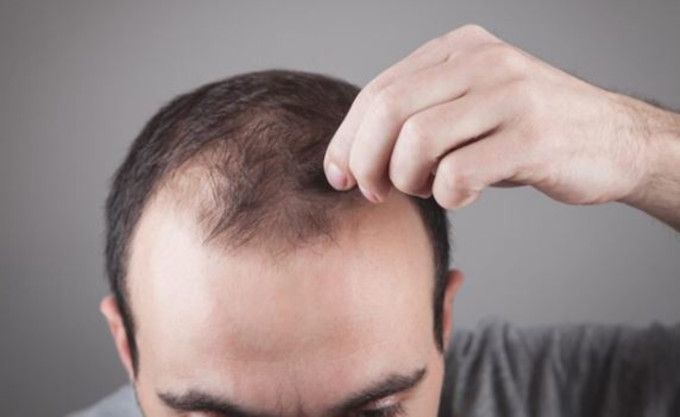 La primera impresion sobre las protesis capilares para la pérdida de cabello