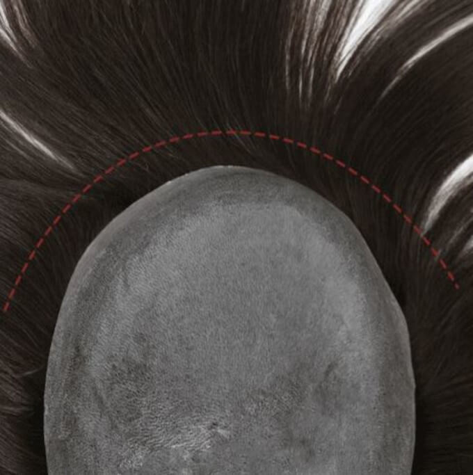 Prótesis Capilar Indetectable para Hombre de Cabello Inyectado