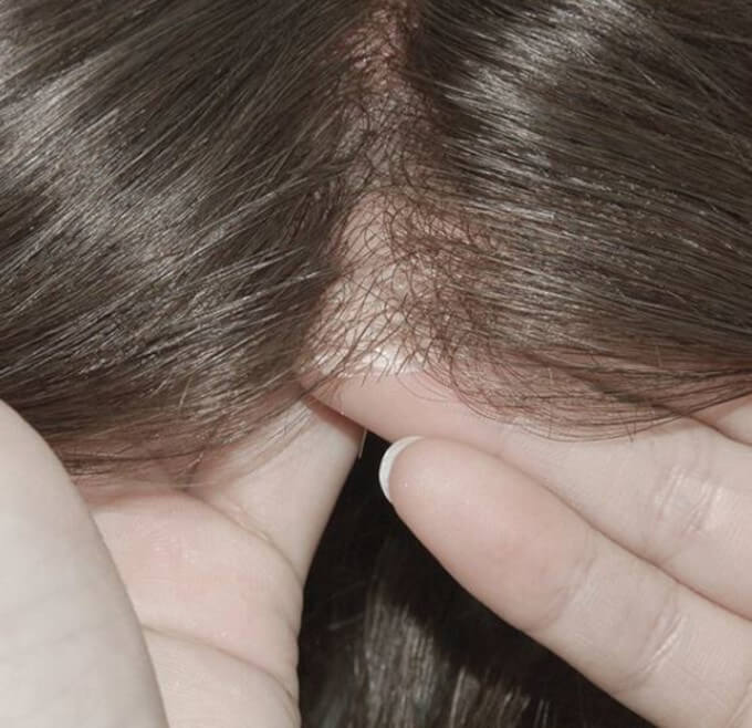 Las prótesis capilares de skin son cómodas de usar