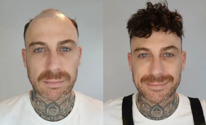 Protesis Capilar de Encaje Champion de Lordhair - Antes y Después