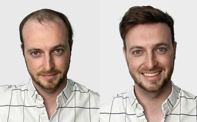 Protesis Capilar de Monofilamento Vigor de Lordhair - Antes y Después