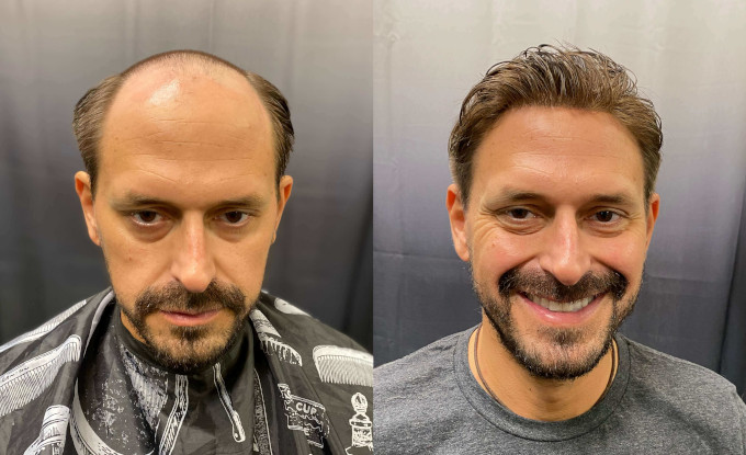 Protesis Capilar Personalizada para Hombre - Las mejores