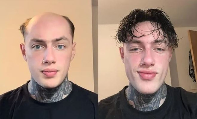Protesis Capilar de Skin UTS de Lordhair - Antes y Después