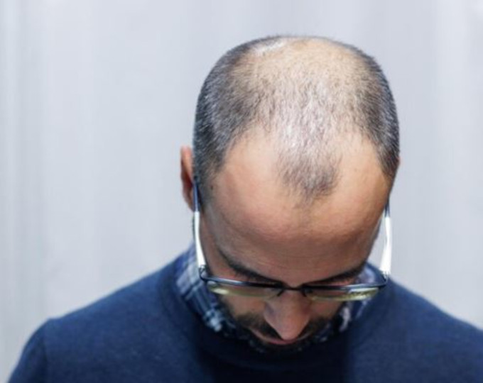 calvicie de patron masculino y protesis capilares como solución