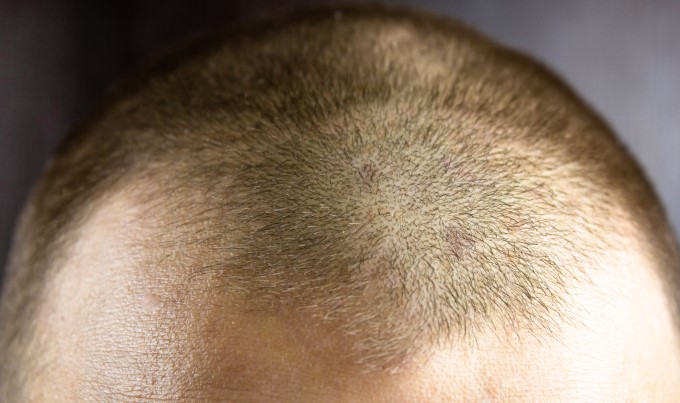 recesión de la línea del cabello- ¿crecerá si me rapo?