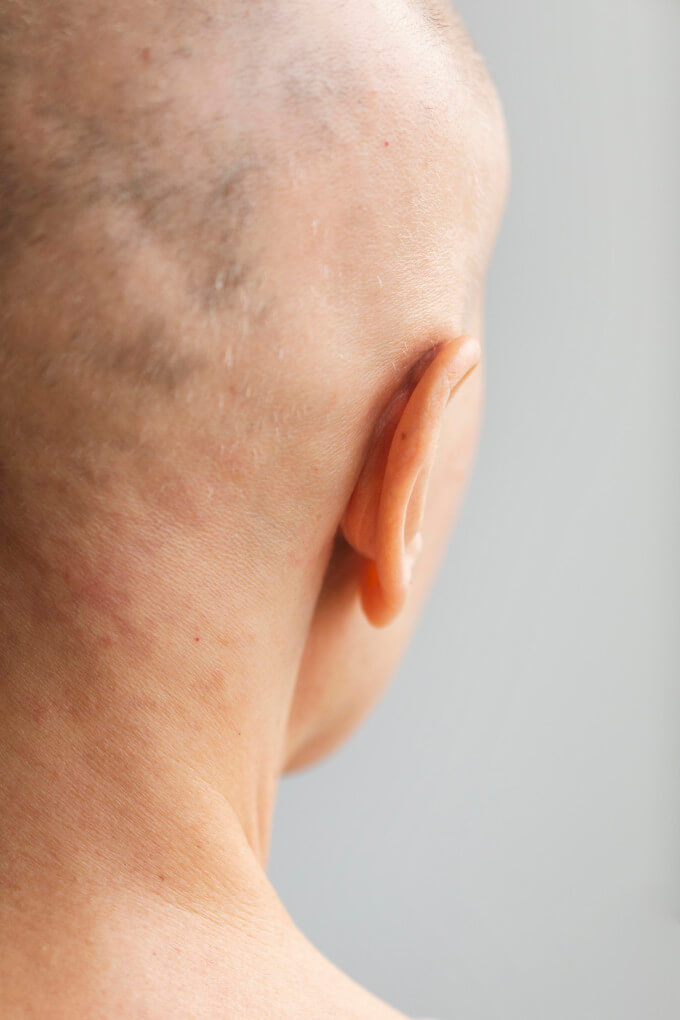 Alopecia