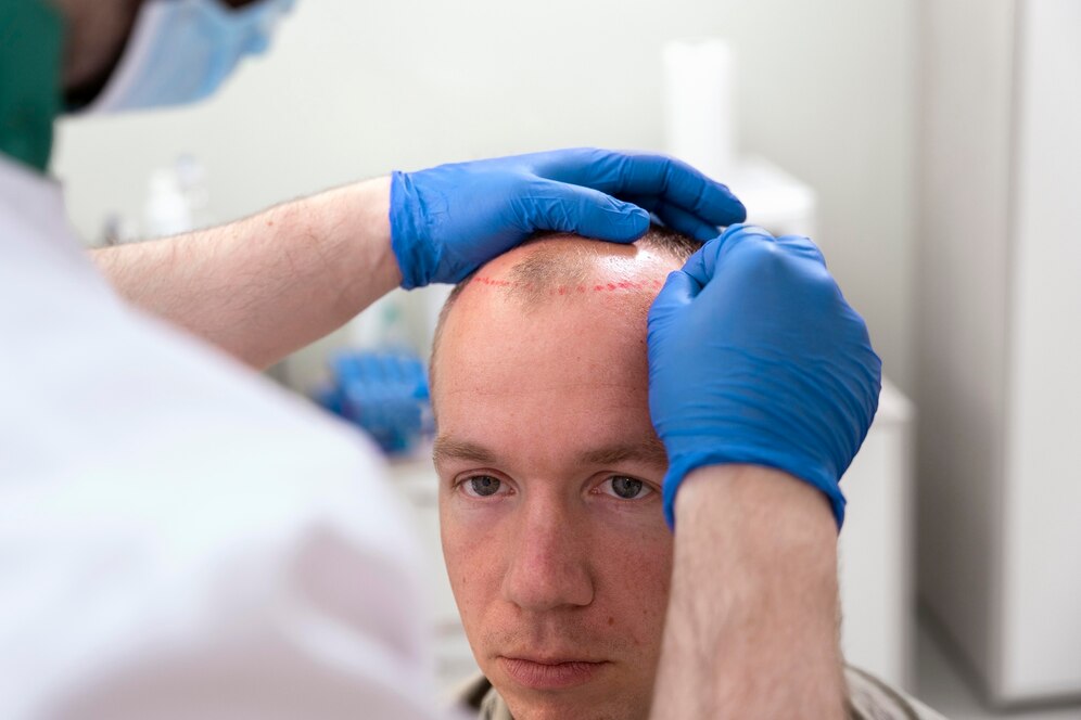 Tratamiento PRP para la recuperacion de cabello