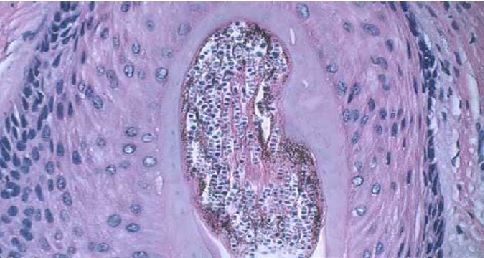 Pérdida de Cabello por Tinea Capitis- Vista Microscópica